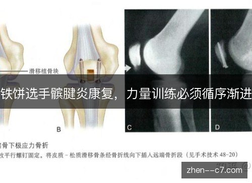 铁饼选手髌腱炎康复,力量训练必须循序渐进 铁饼选手髌腱炎康复,力量训练必须循序渐进
